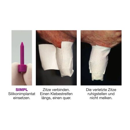 SIMPL ﻿Das erste Silikonimplantat für Zitzen | 20 Stück
